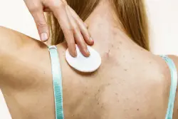 Adults with acne are at higher risk of eating disorders